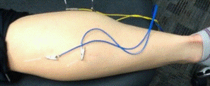 person's calf with needles and wires attached
